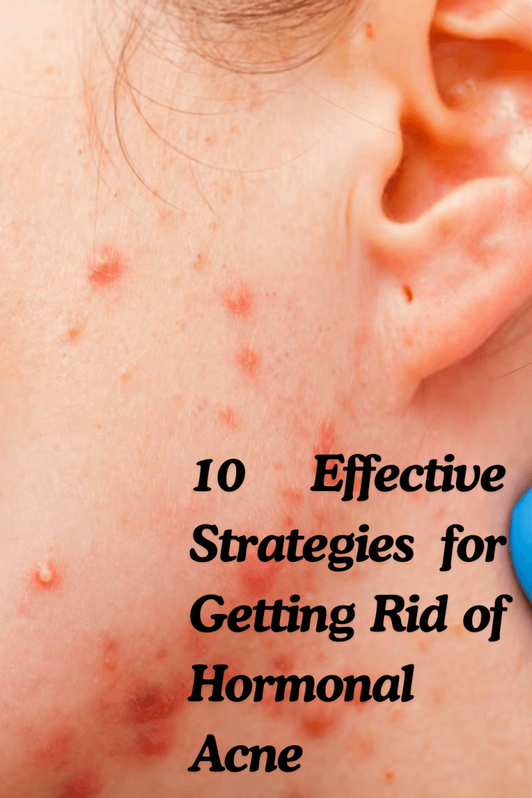 10 Effective Strategies for Getting Rid of Hormonal Acne