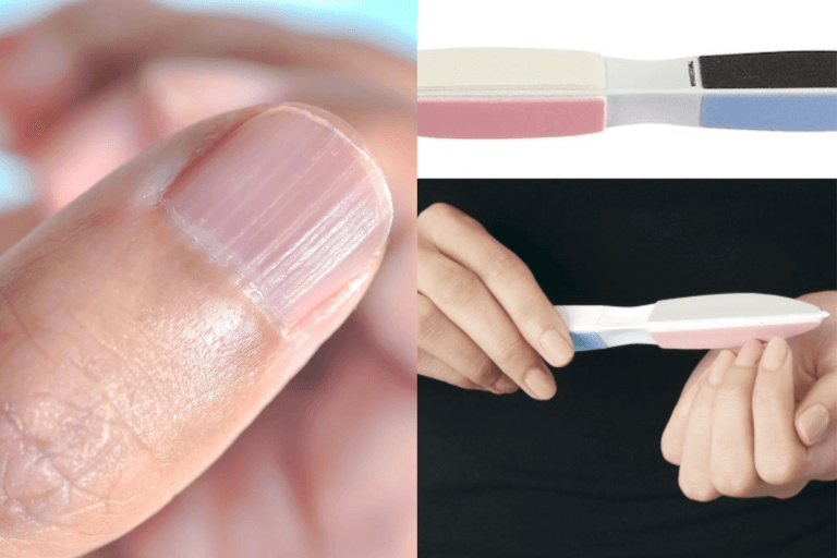 What do Those Unsightly Lines on my Nails Represent?